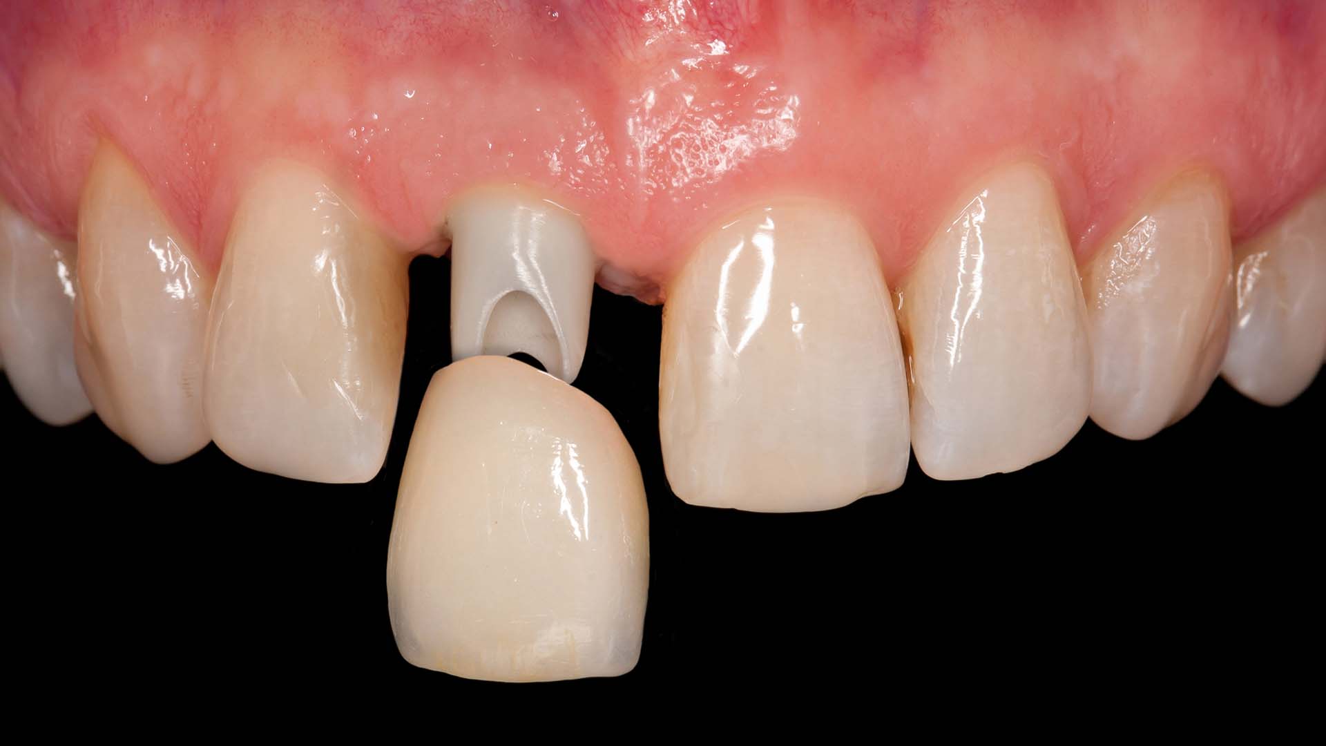 Image of a dental crown. Ivy Lane Dentistry offers dental crowns in San Antonio, TX.