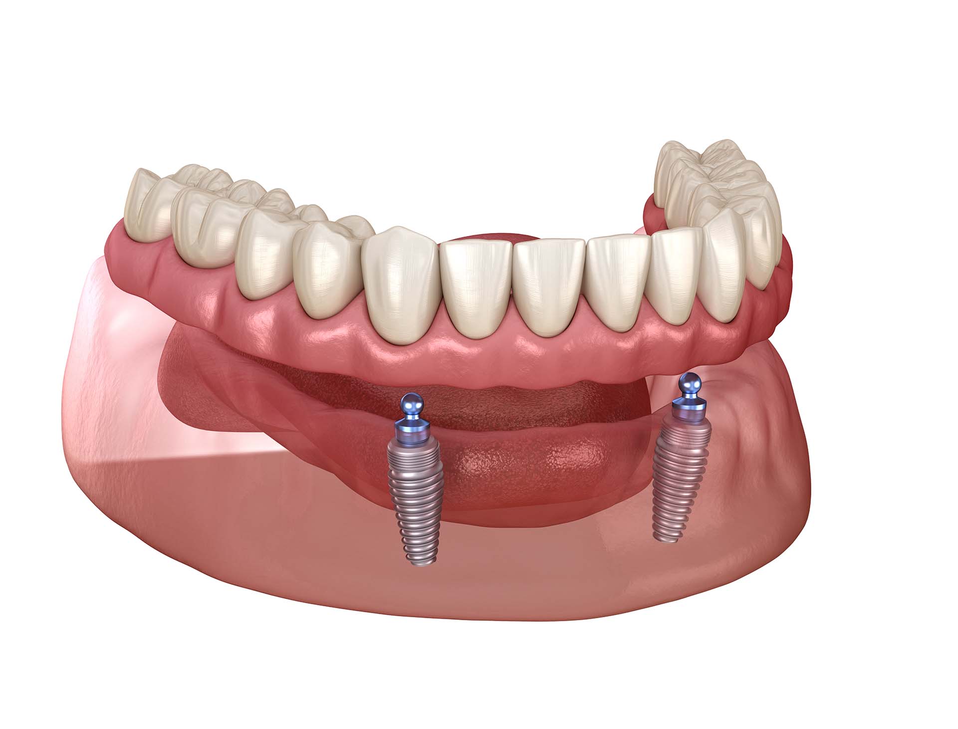 Mandibular removable prosthesis All on 2 system supported by implants with ball attachments. Medically accurate dental 3D illustration