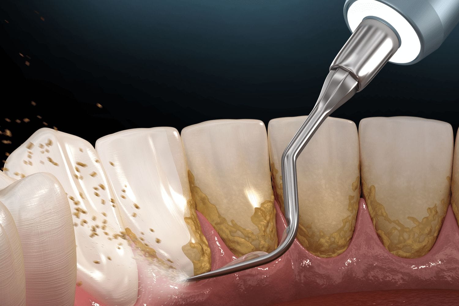 Tartar being removed with a scraper from a tooth. Ivy Lane Dentistry offers scaling and root planing in San Antonio, TX.