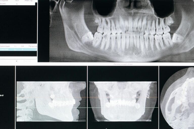 Maintaining Bone Health Post-Extraction